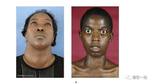 甲亢可以吃菓瓜吗,菓瓜可否食用？