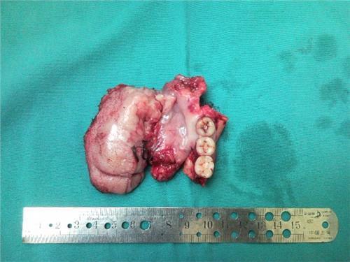 吃蜜瓜舌头烂了,揭秘蜜瓜为何导致舌头烂了