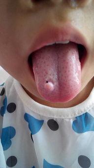 吃蜜瓜舌头烂了,揭秘蜜瓜为何导致舌头烂了